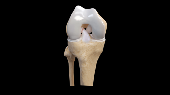 Anterior Cruciate Ligament (ACL) Tears