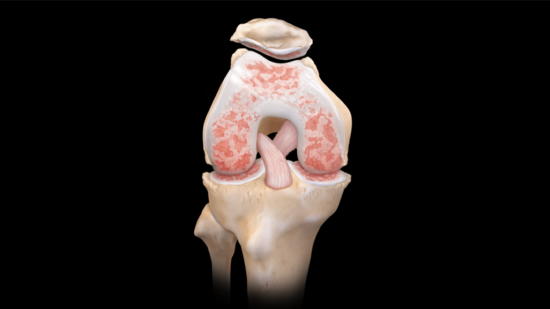 Knee Arthritis